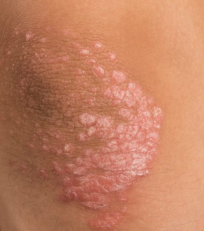 Living With Psoriasis - FMC