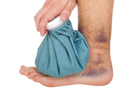 How to Treat a Sprained Limb at Home