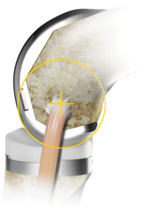 Knee with circular Triathlon Knee Implant