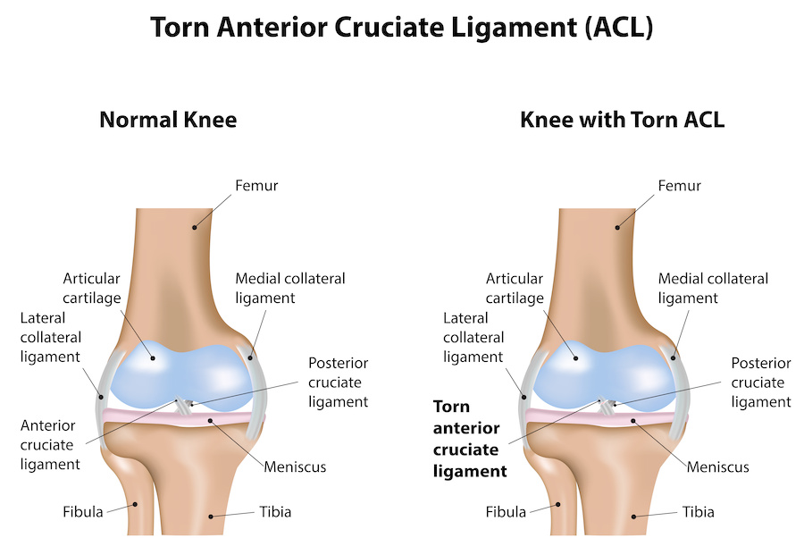 torn ACL diagram