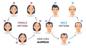 Alopecia hair thinning cycle for men and women