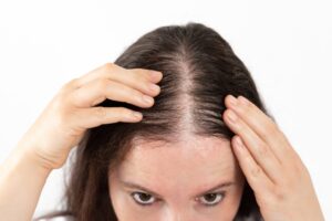 Woman inspecting her hair loss spreading on her scalp