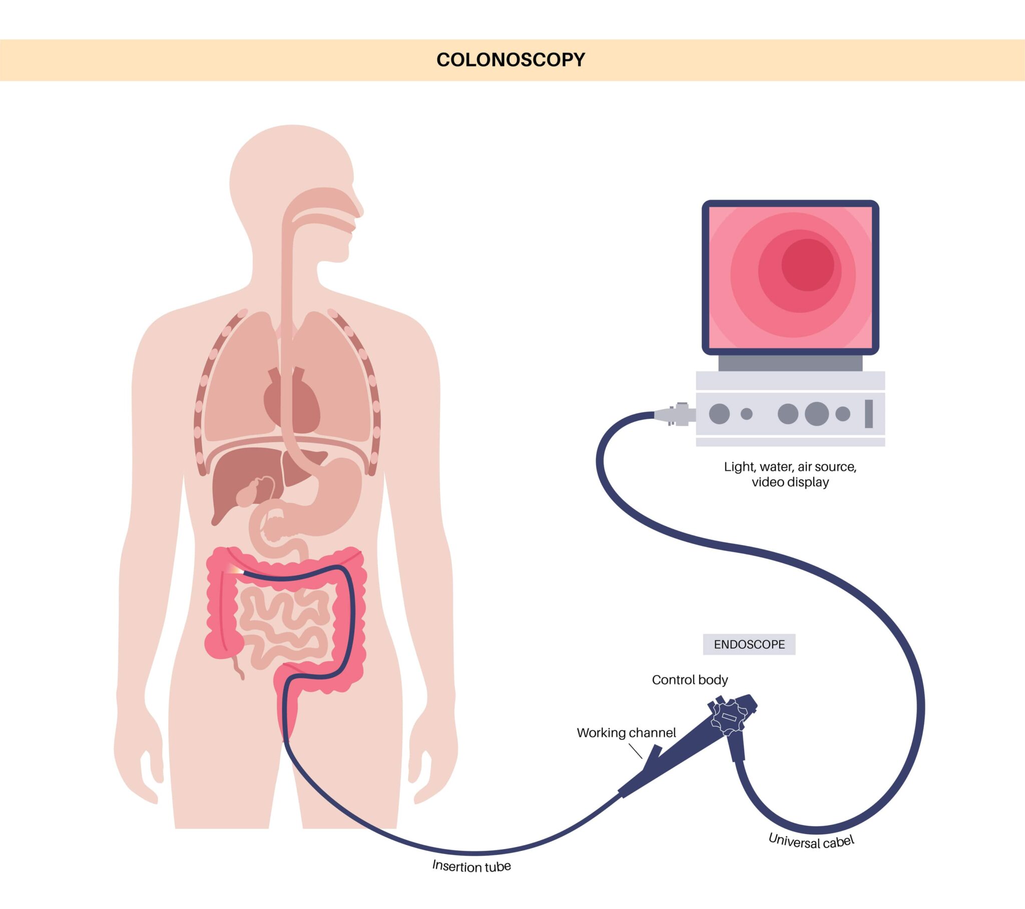 colonoscopy screening test using an endoscope with fiber optic camera to screen for colorectal cancer