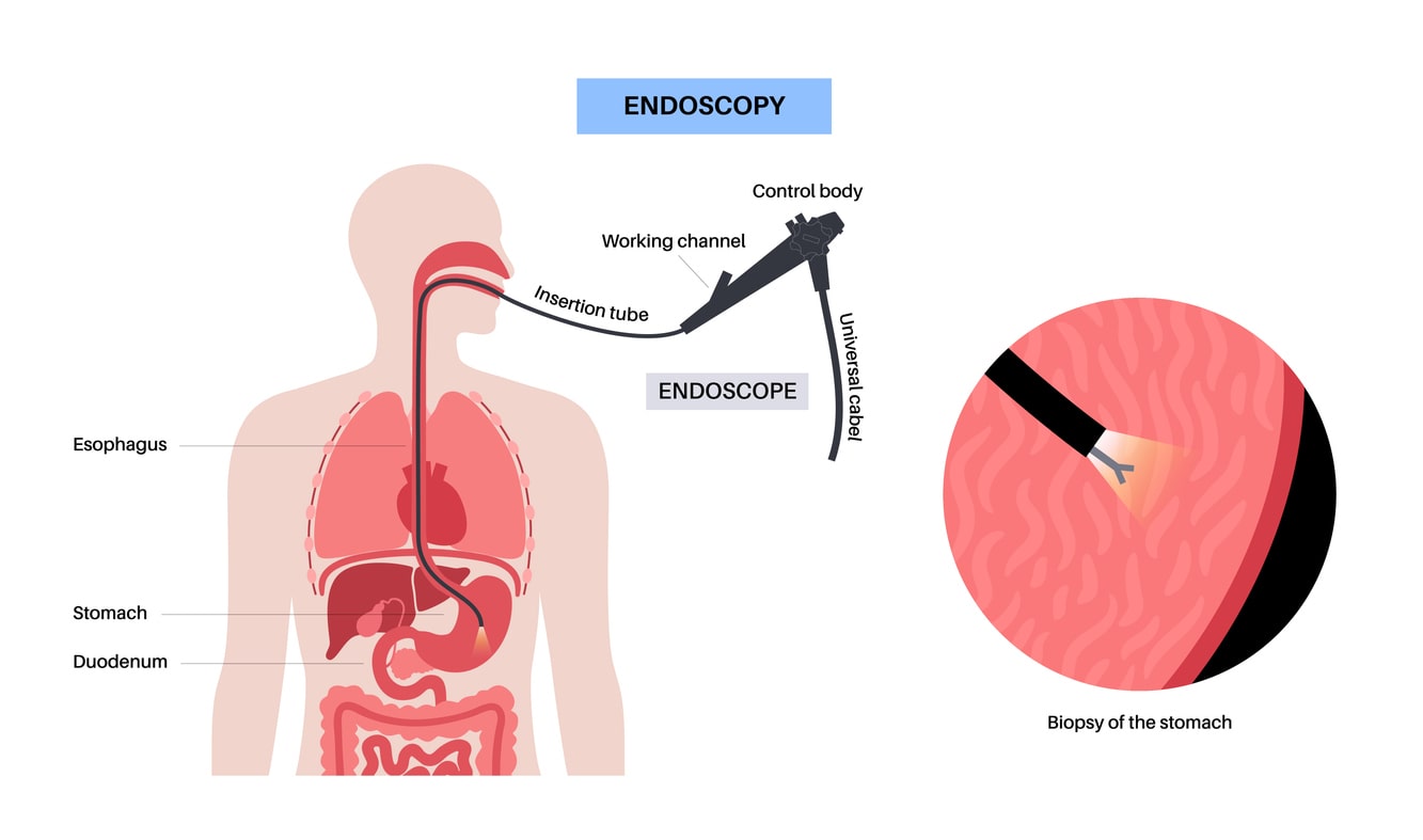 endoscopy screening test using an endoscope with fiber optic camera to screen for colorectal cancer