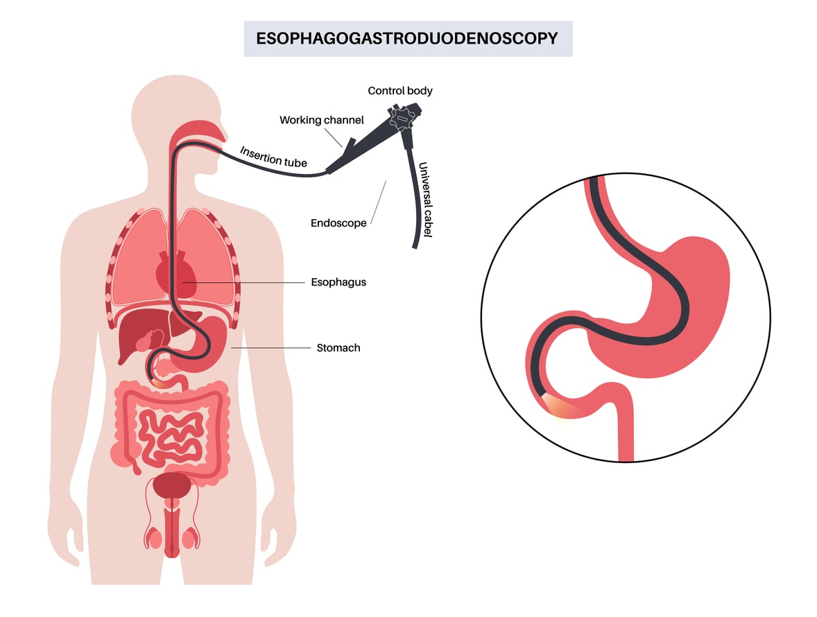 esophagogastroduodenoscopy screening test using an endoscope with fiber optic camera to screen for colorectal cancer
