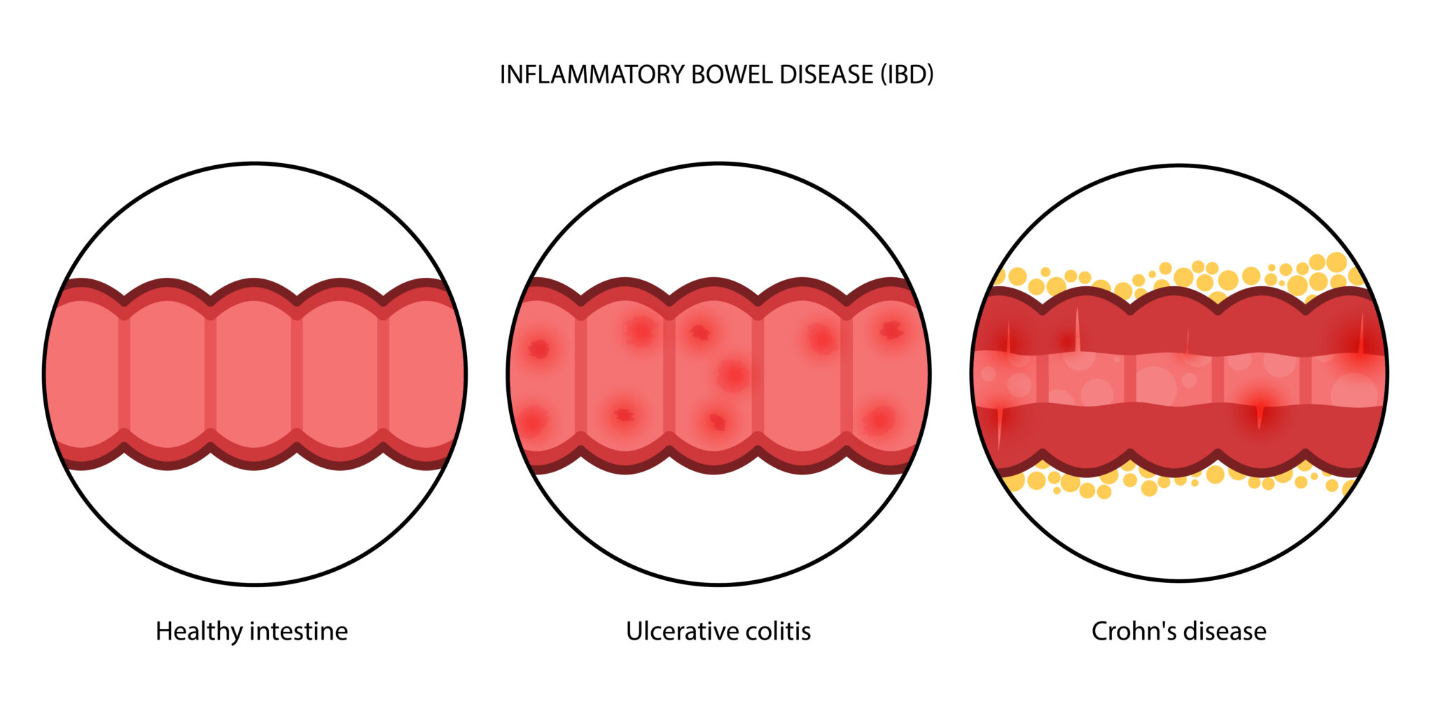 Inflammatory bowel disease. Crohns disease, ulcerative colitis and healthy intestine. Inflammation of the digestive tract, abdominal pain in colon. Anatomical medical poster flat vector illustration.