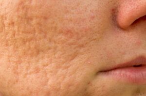 close up of skin with acne marks