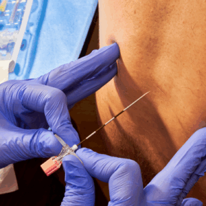 physician giving a patient an epidural injection for back and leg pain