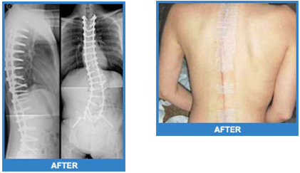Adult Scoliosis After Surgery