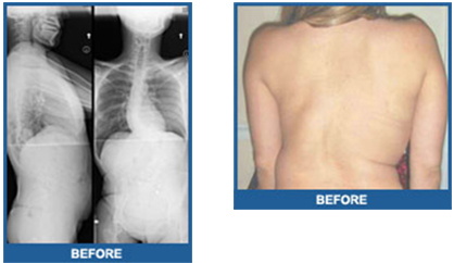 Adult Scoliosis Before Surgery