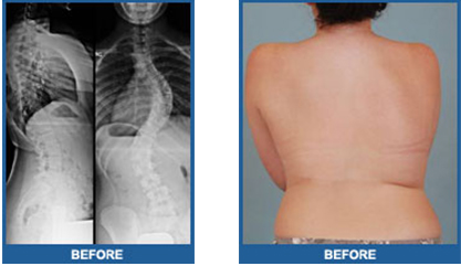 scoliosis_before